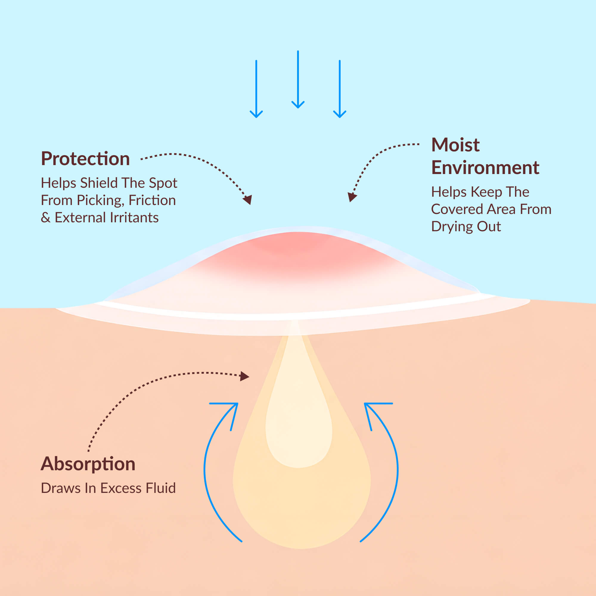 Diagram of CLERIVY Hydrocolloid Pimple Patch absorbing excess fluid and protecting a surfaced spot.