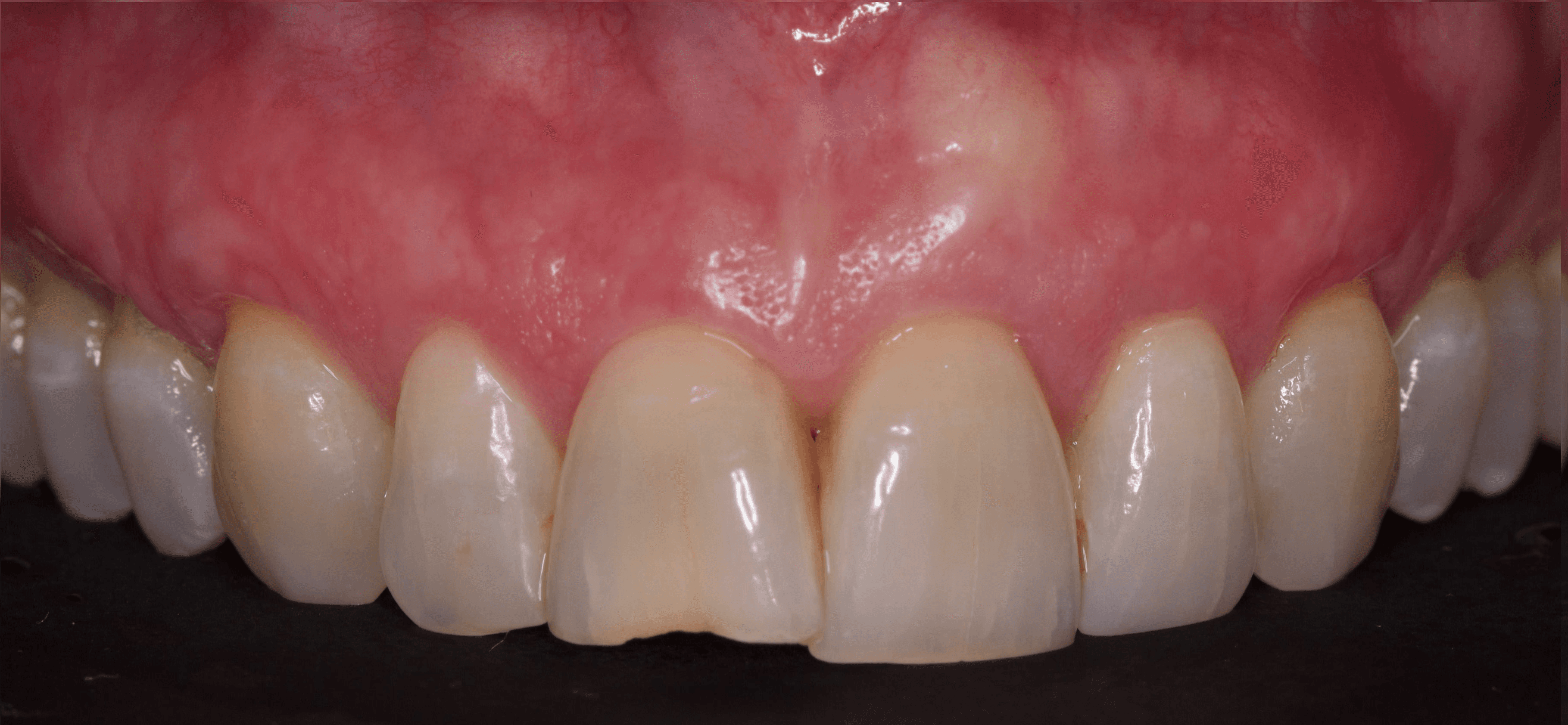 After treatment of receding gums at Bloor-Yorkville Periodontics