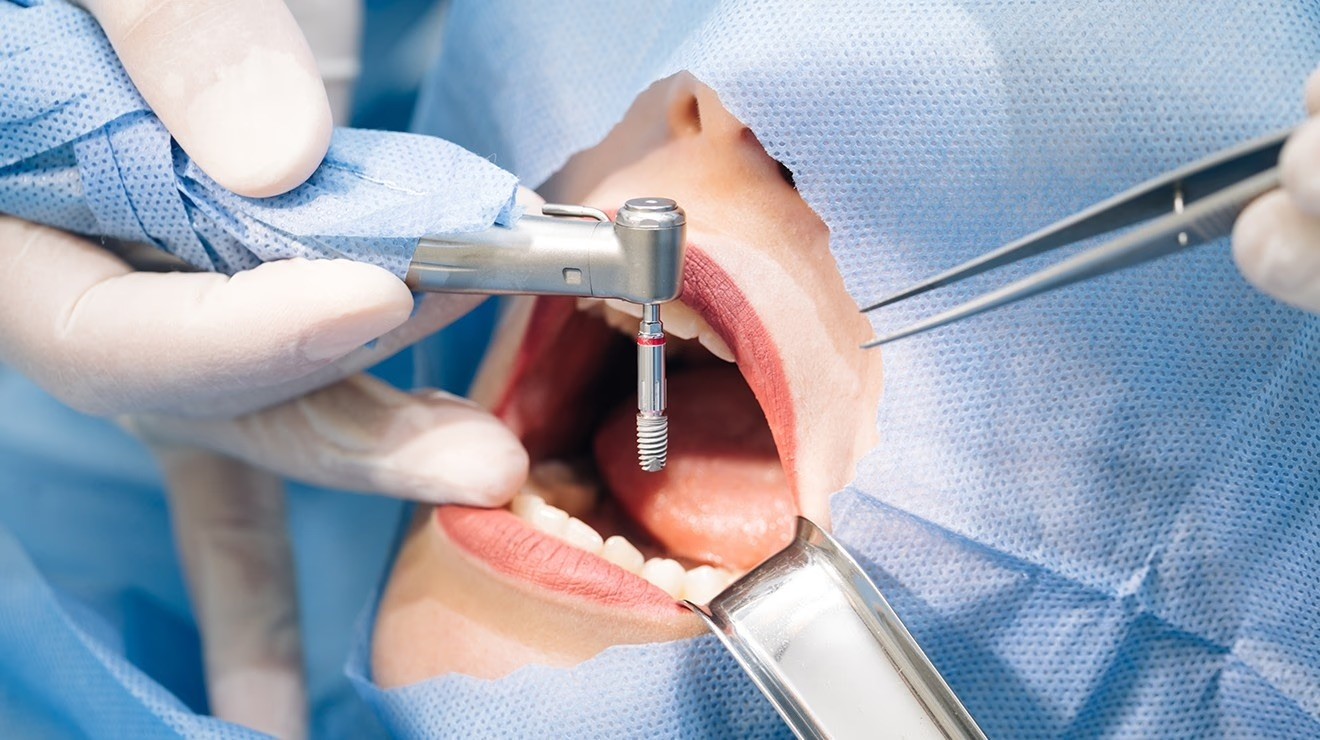 A girl getting porcelain veneers in Abu Dhabi to achieve a Hollywood smile at Bella Medical Centre. 