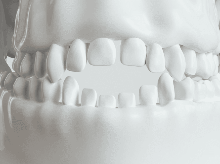 Open Bite: What It Is and How It Affects Your Smile