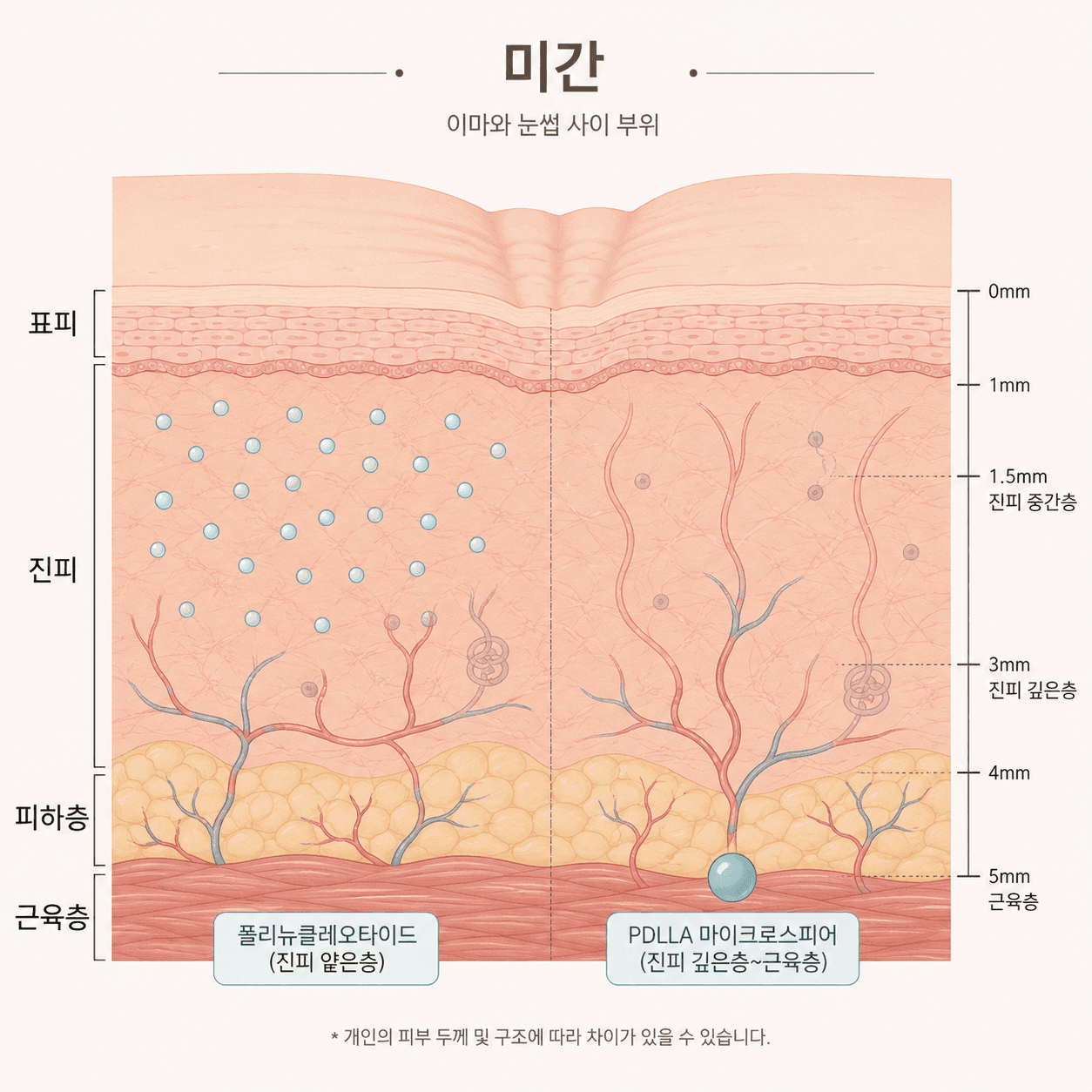 피부 층에 얕게 나눠 넣는 자리와 근육 층까지 닿는 자리