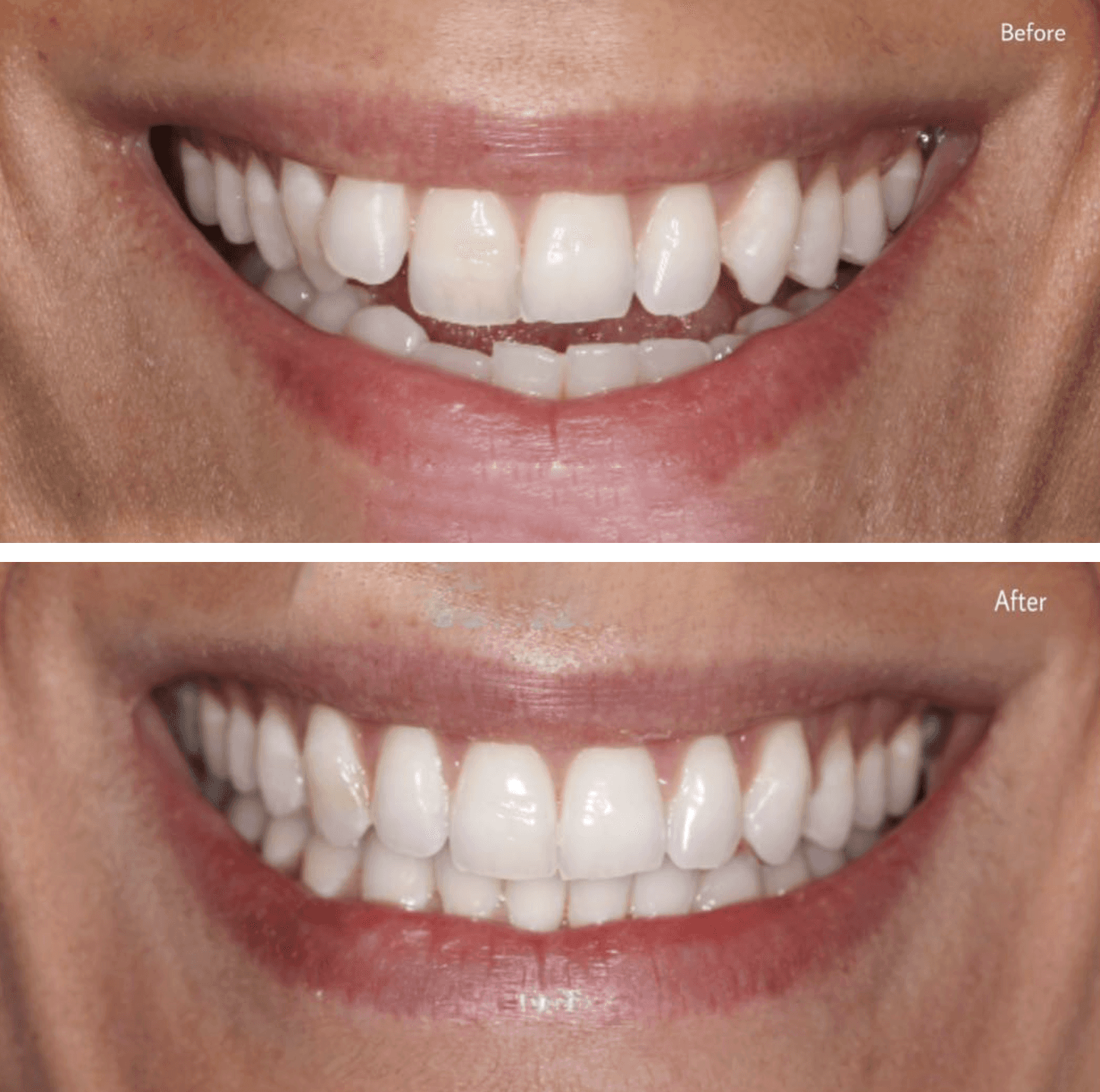 A photo of invisalign before and after  featuring a transformation to perfectly aligned teeth at the Invisalign Center in Dubai