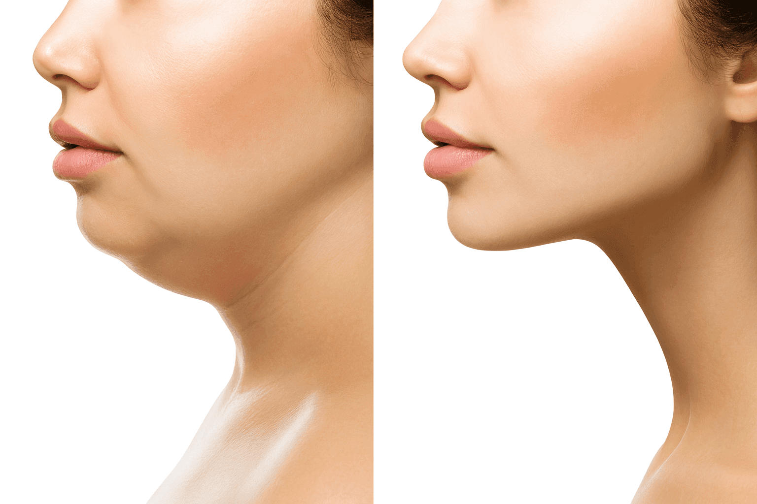 Before and after results of Kybella double chin reduction treatment showing a slimmer, more defined jawline without surgery.