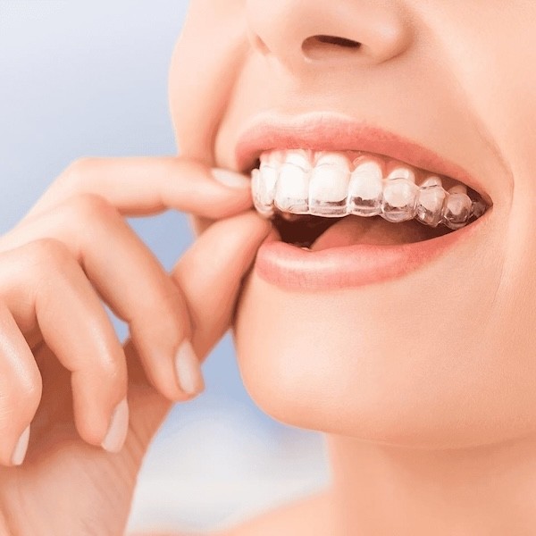 Clear Braces: invisalign treatment
