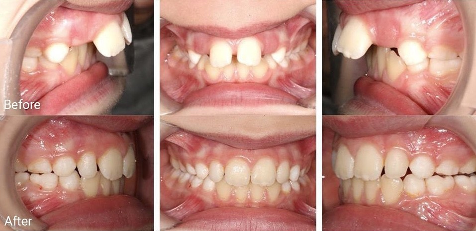 Invisalign® before and after result featuring improved alignment of severely spaced front teeth and fixed overbite in Dubai, UAE.
