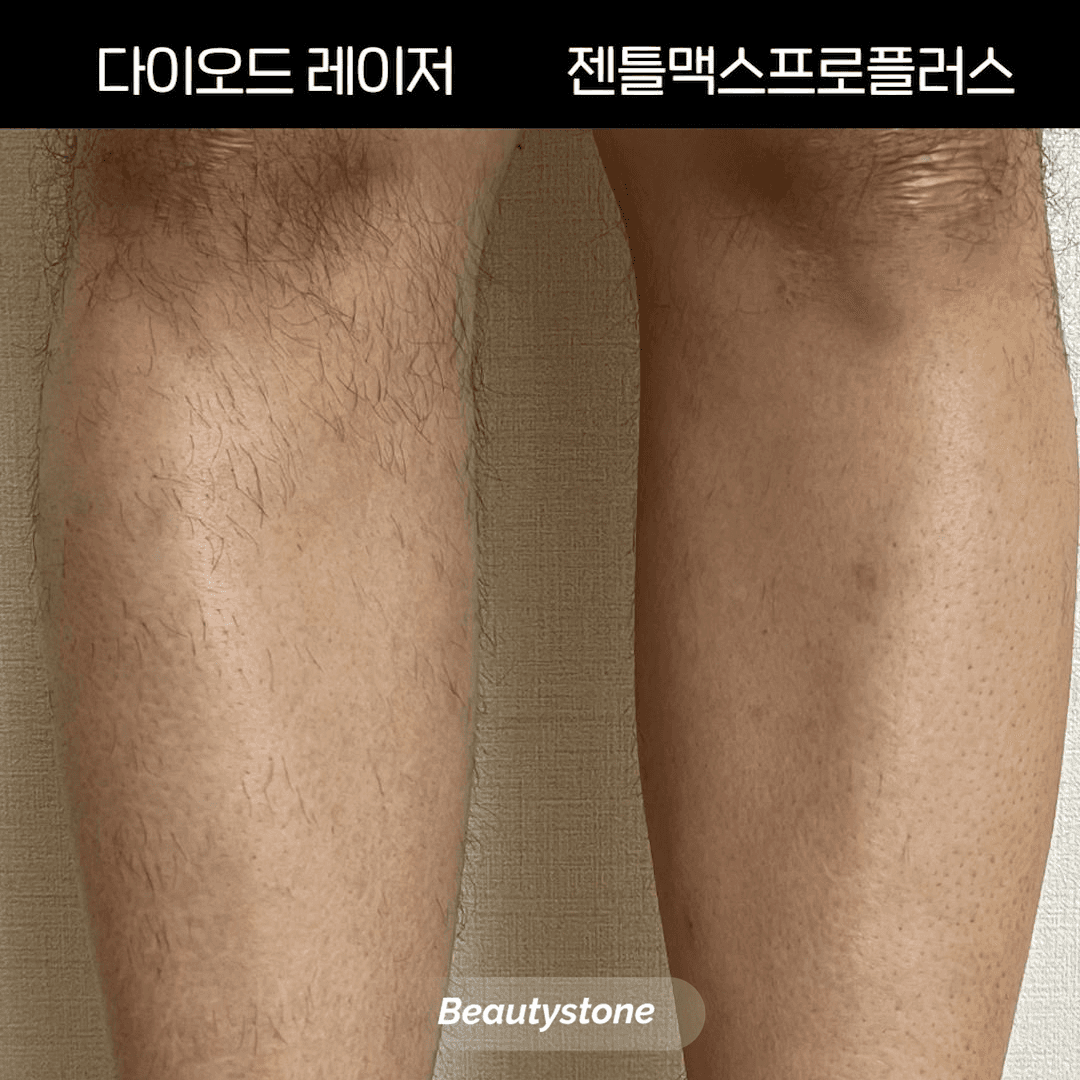 왁싱의 통증이 두렵다면? 젠틀맥스 프로 플러스로 시작하는 저통증 다리 제모