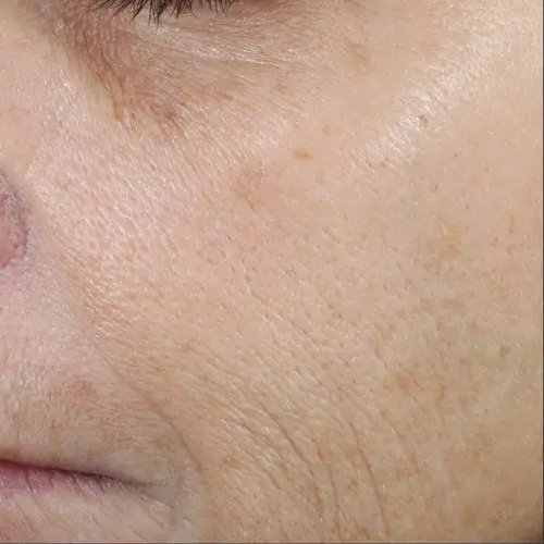 After antioxidant treatment at The Vancouver Aesthetician — cheek and smile line wrinkles visibly reduced and skin noticeably brighter and more luminous