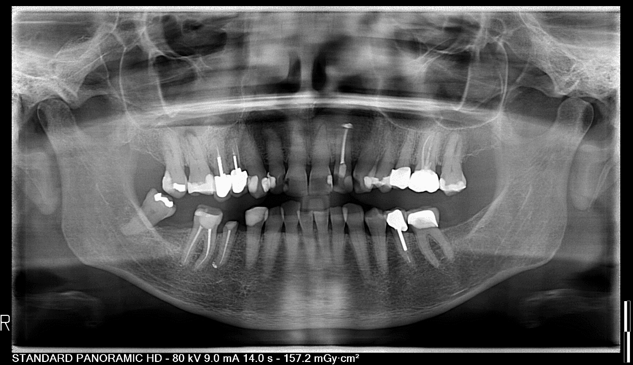 De panoramische gebitsfoto