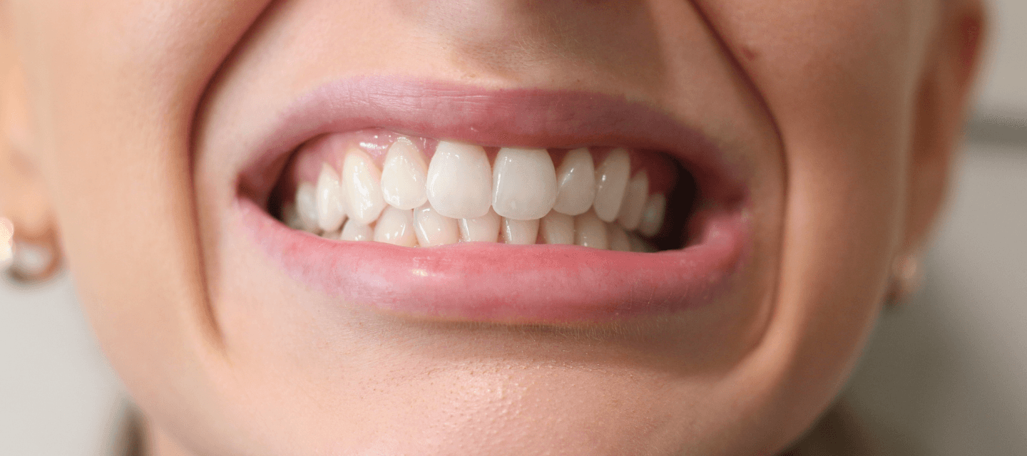 What Really Happens During a Smile Makeover: A Step-by-Step Guide