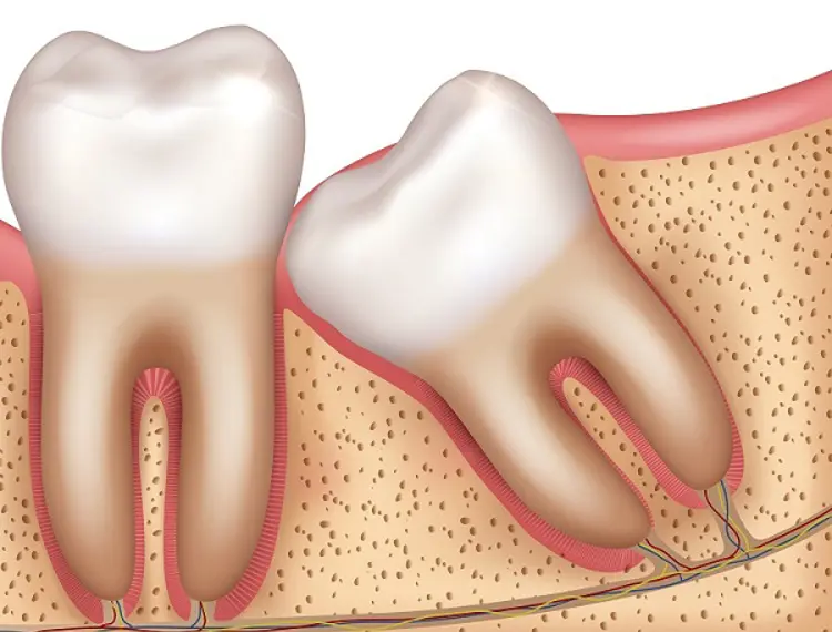 wisdom tooth