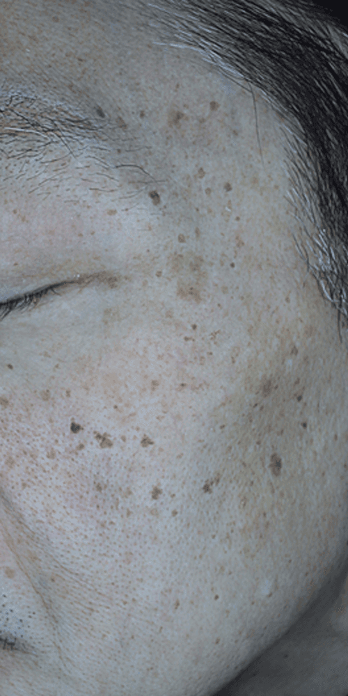 Pigmentation - Before