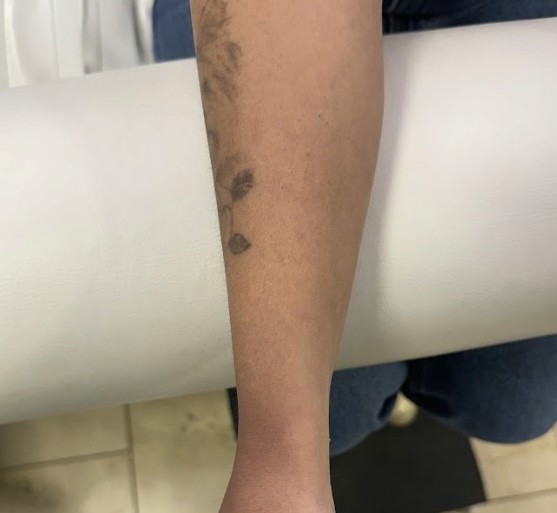 Imagem de antes e depois da remoção de tatuagem