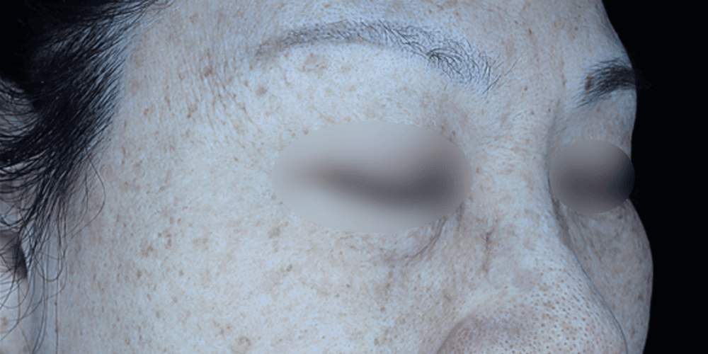 Pigmentation - After