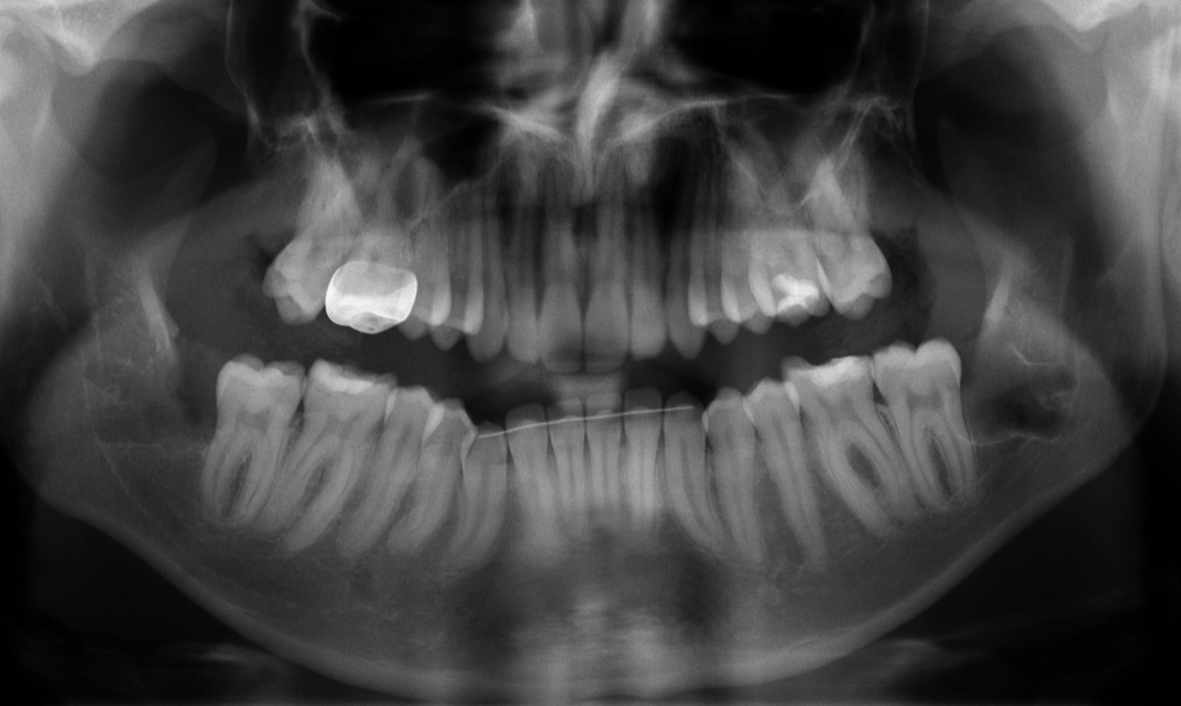 A panoramic dental X-ray showing a clear view of both upper and lower jawbones, with one visible dental filling in the upper teeth, capturing detailed tooth alignment and bone structure at Oakville Dental Implant Studio.