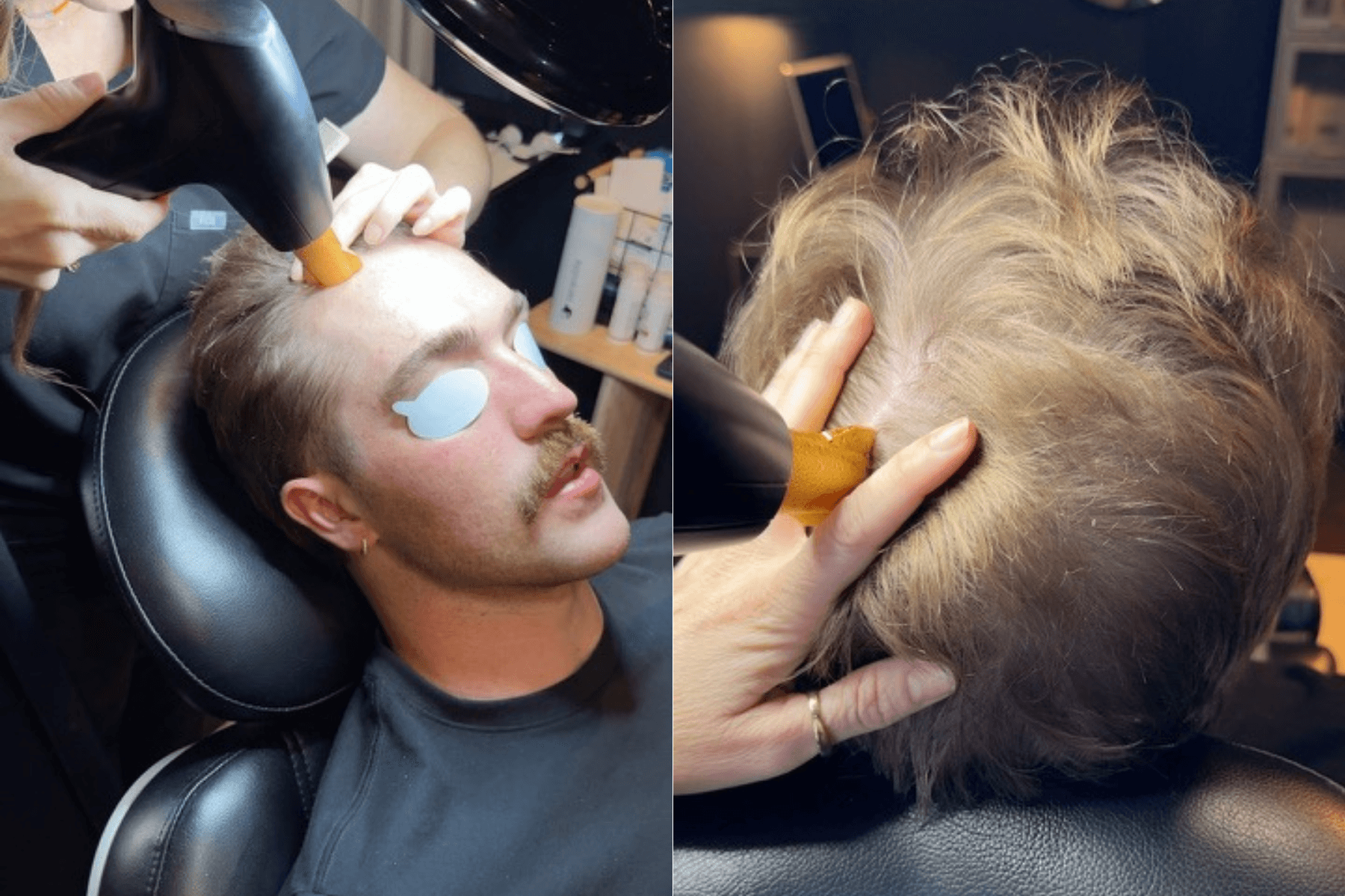 Man receiving FoLix laser treatment for hair growth