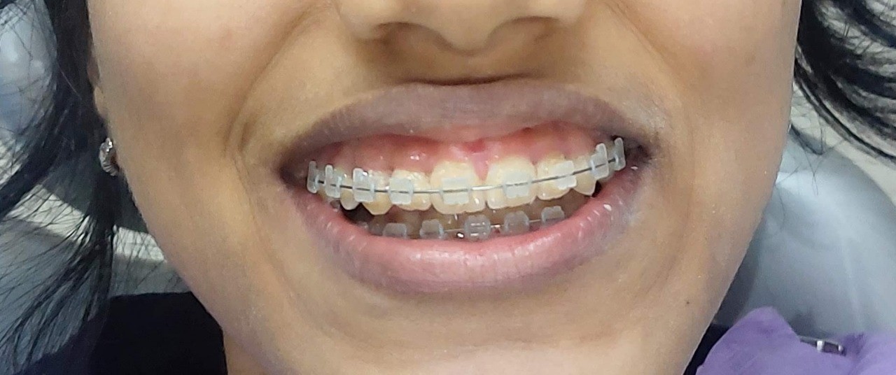 Ceramic braces image