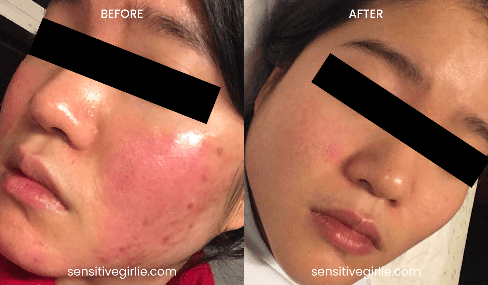 หน้าแพ้สารสเตียรอยด์