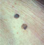 Figure 4: Seborrhoeic keratosis