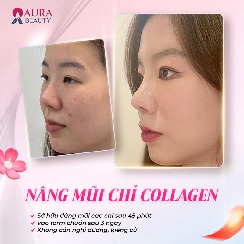 Nâng mũi chỉ collagen tại Aura