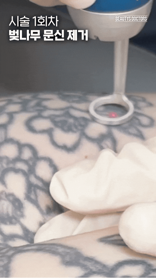 컬러문신제거 피코웨이 시술 전후   — 홍대 뷰티스톤의원