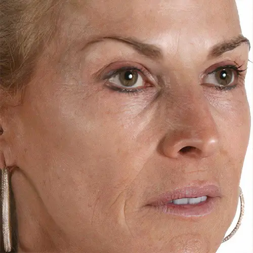 Before growth factors anti-aging treatment at The Vancouver Aesthetician — tired looking skin with visible wrinkles, sagging and dull complexion