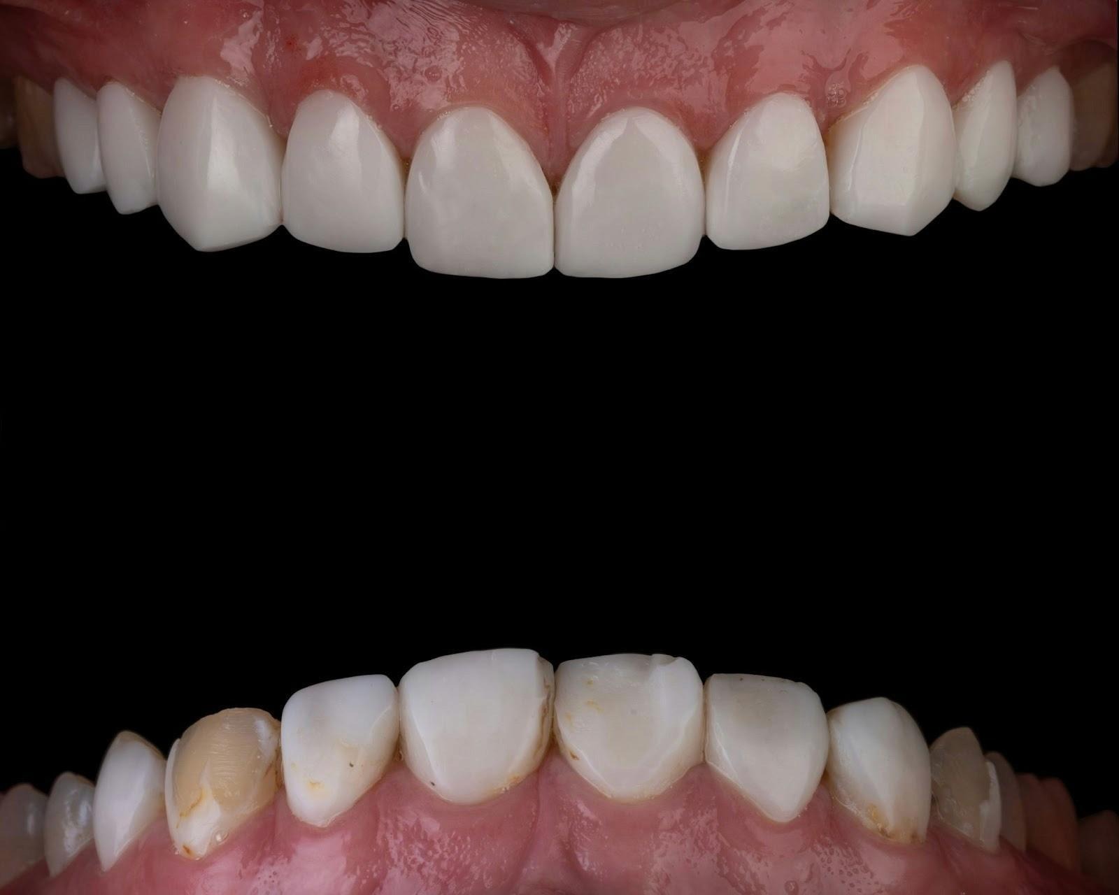 صورة تُقارن بين أسنان مصفرة متضررة وأخرى بيضاء مثالية، تبرز فعالية علاج لالتهاب اللثة.