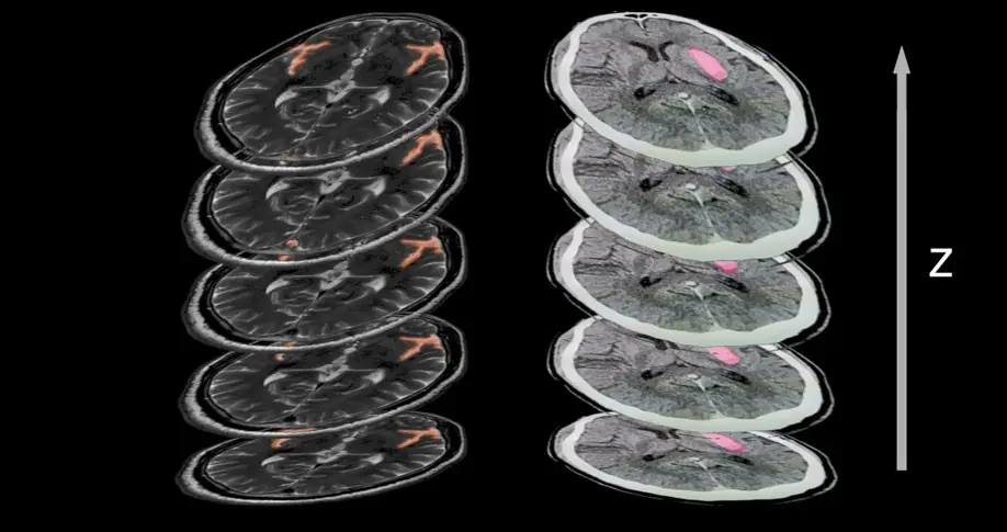 Brain MRI slices showing lesions