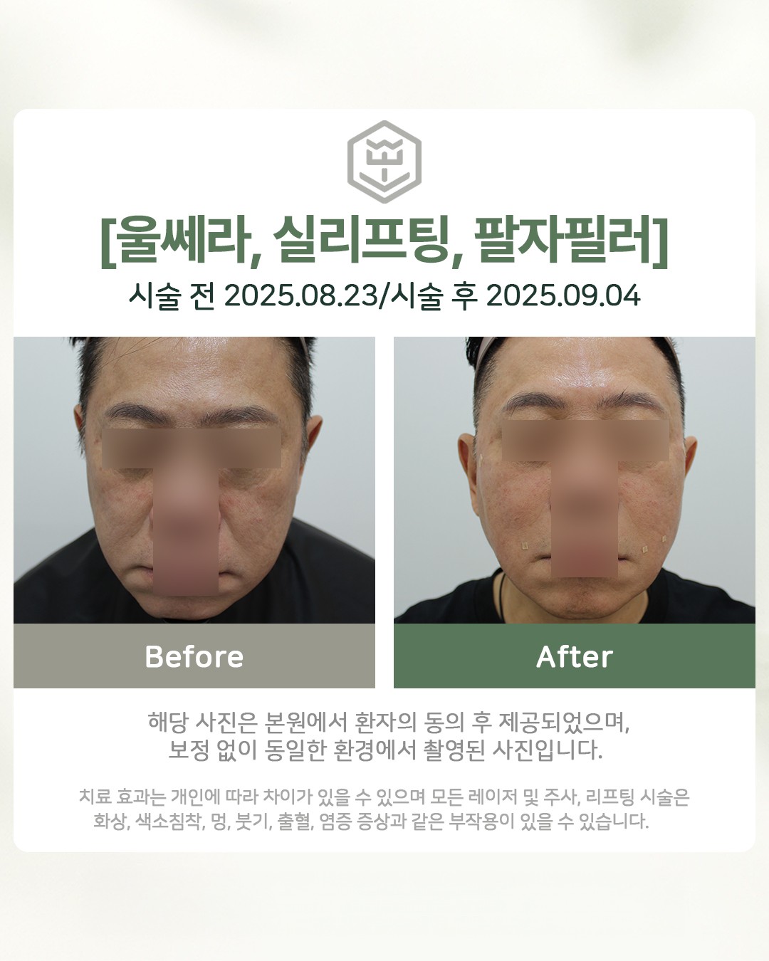 울쎄라+실리프팅+팔자필러