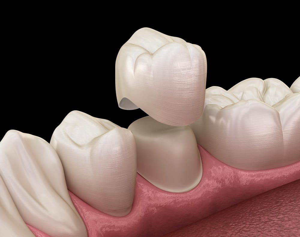 Ceramic dental crown restoration tooth treatment