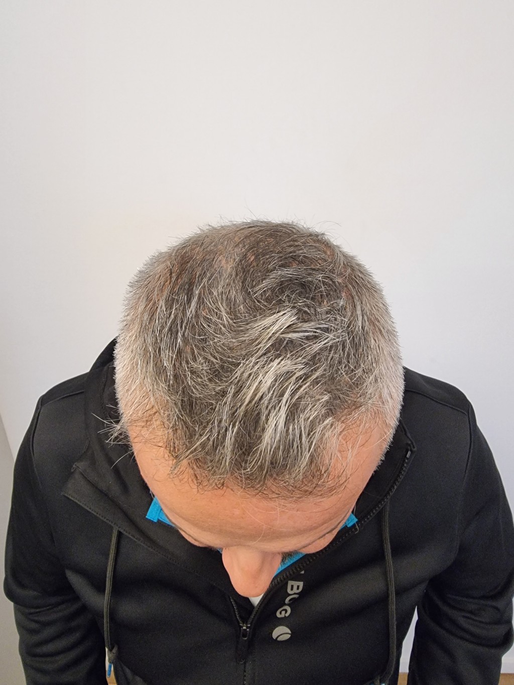 Micro haar pigmentatie Alluris