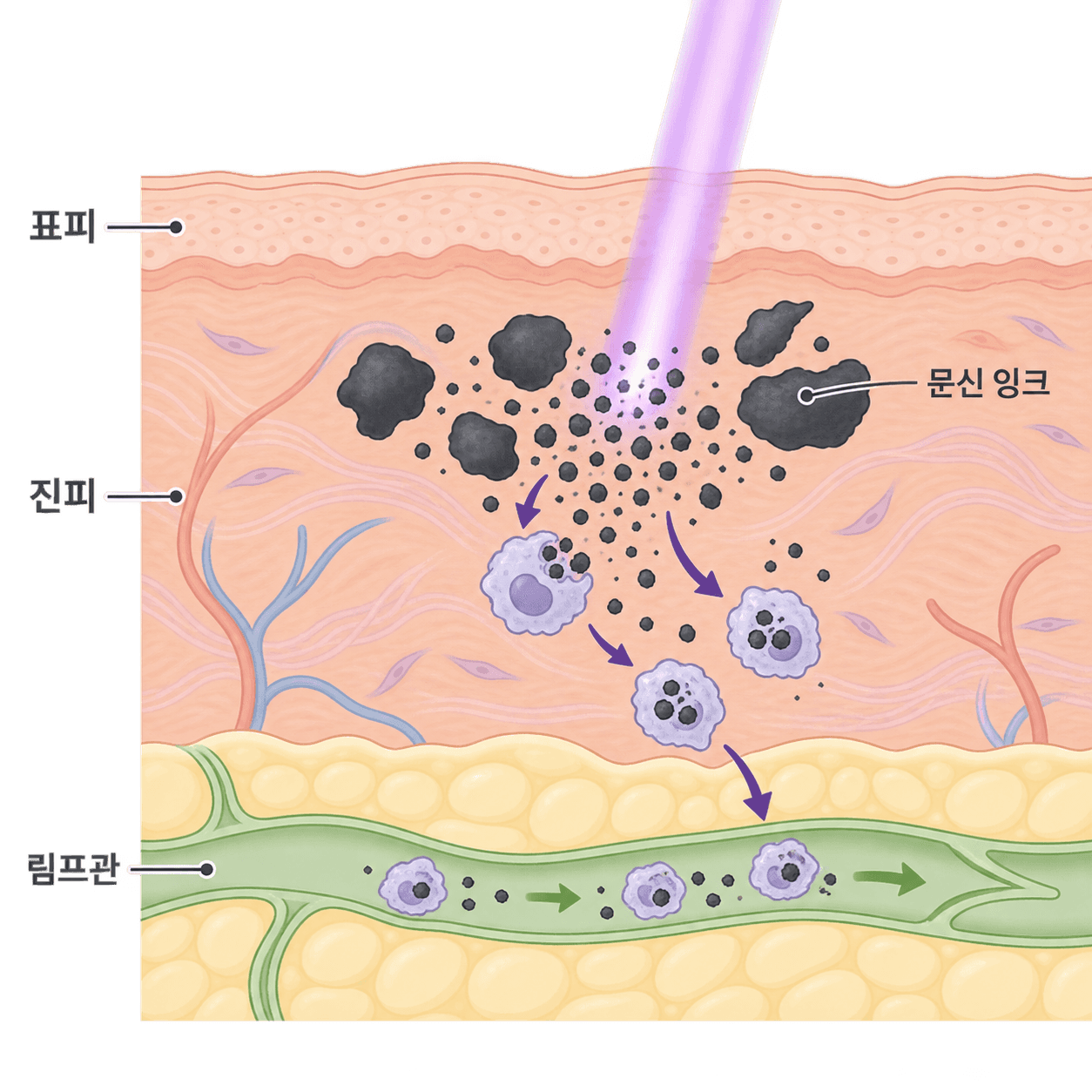 레이저가 부순 잉크는 몸이 림프관을 따라 조금씩 내보내요