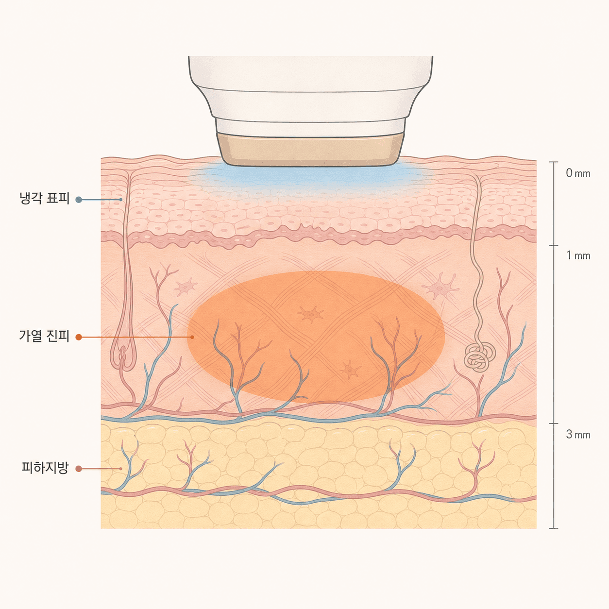 표면은 식히고 진피만 데우는 써마지의 열 분포