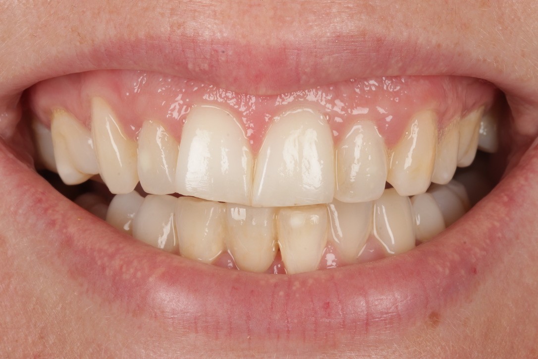 Frontal smile before composite bonding