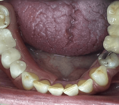 Removable Partial Denture