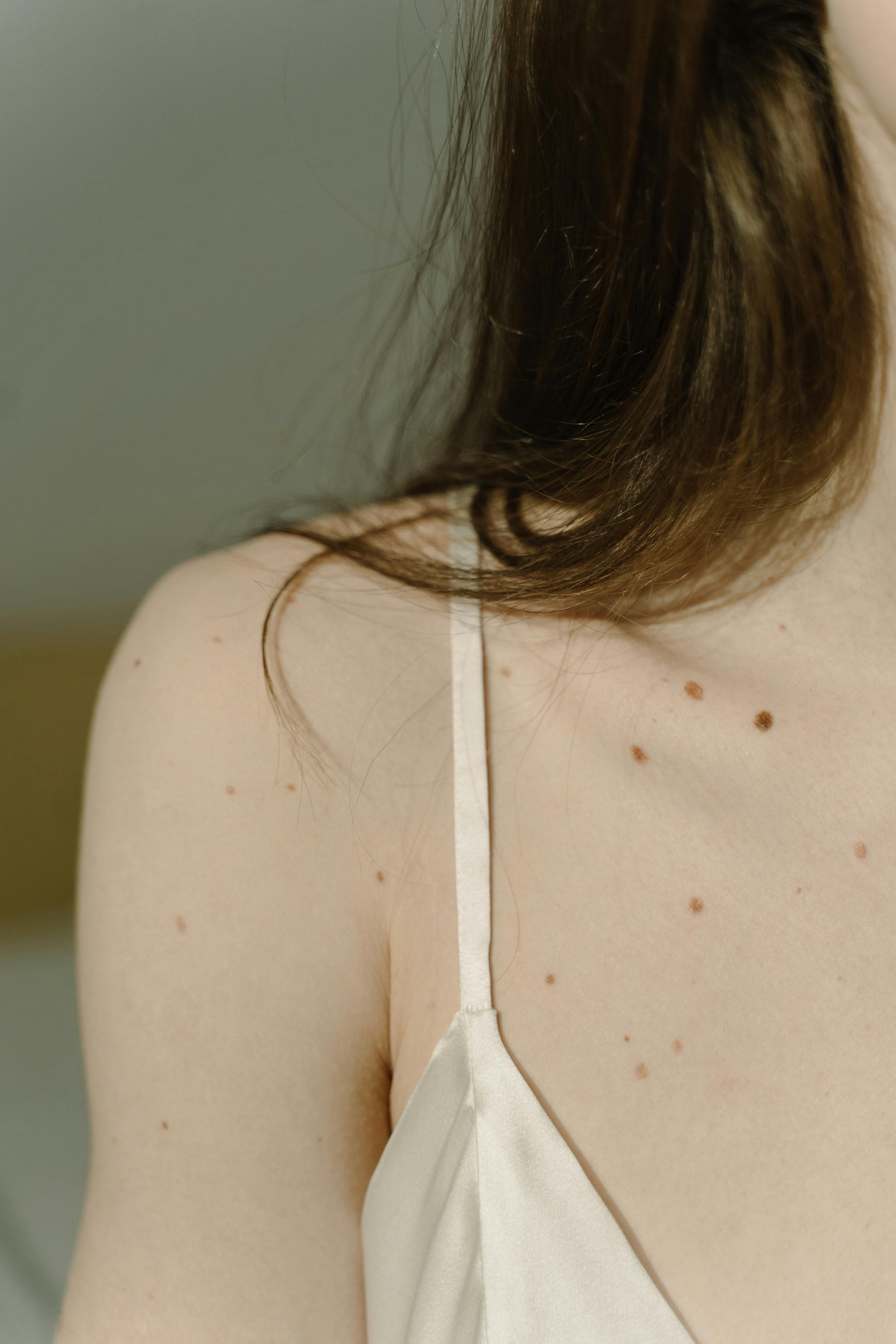 Laser treatment on woman's cheek with protective eye shield
