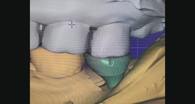 커스텀 어벗트먼트를 완벽한 크라운의 형태로 디자인