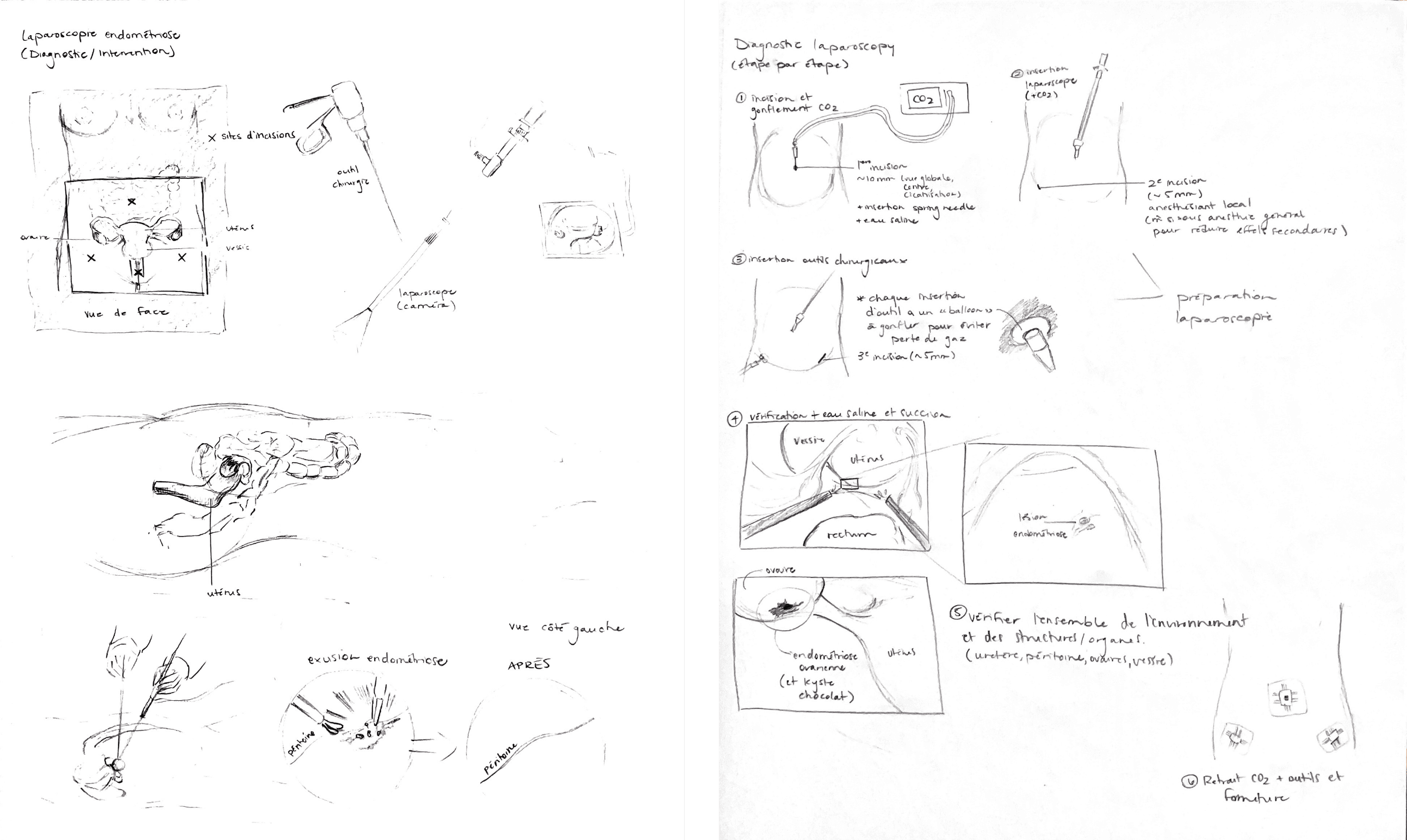 Esquisses manuscrites d'une intervention chirurgicale d'endométriose par Élodie Ouellet-Belleau