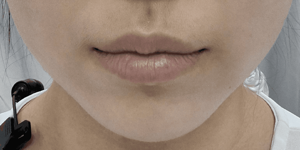 Lip Filler - Before