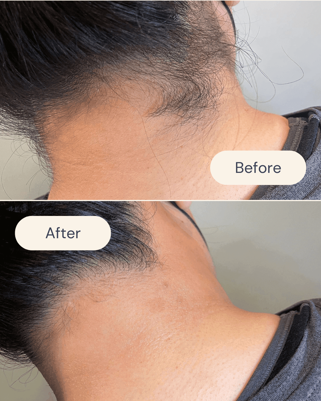 back of neck waxing before and after showing a clean, smooth finish