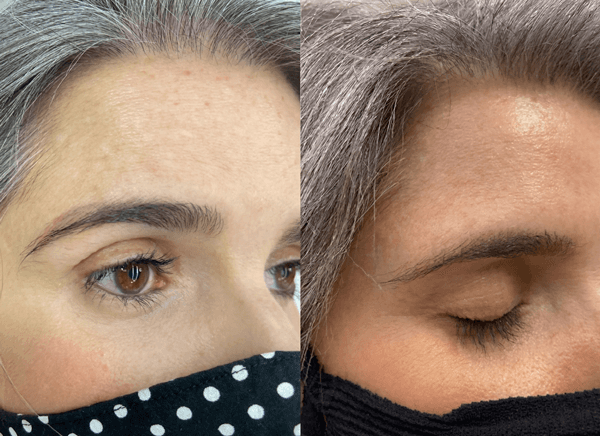 Imagem de antes e depois da remoção de tatuagem