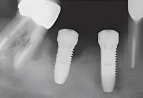 dental implant