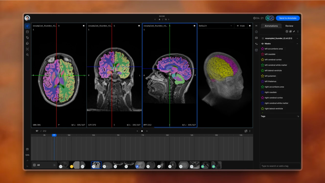 A medical imaging analysis tool displaying multiple MRI brain scans. The interface highlights different brain regions with color-coded segmentation.