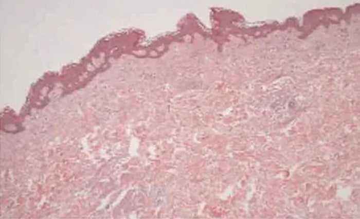 Histologischer Schnitt zwei Wochen nach der Behandlung – abgeschlossene Wundheilung und neuer Kollagenaufbau