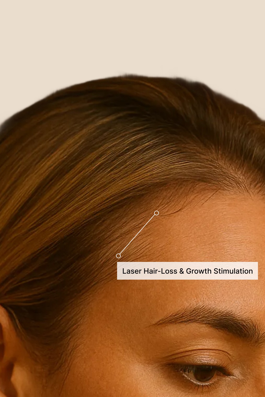 Close-up of a woman’s hairline with an area highlighted for a laser hair-loss and hair-growth stimulation treatment.