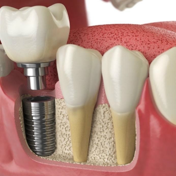 Fogászati implantátum (műgyökér beültetés)