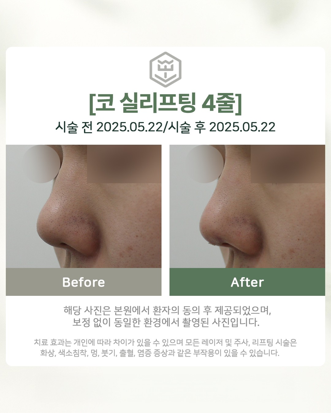 코실리프팅 4줄