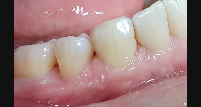 Ceteeth 세팅후 사진