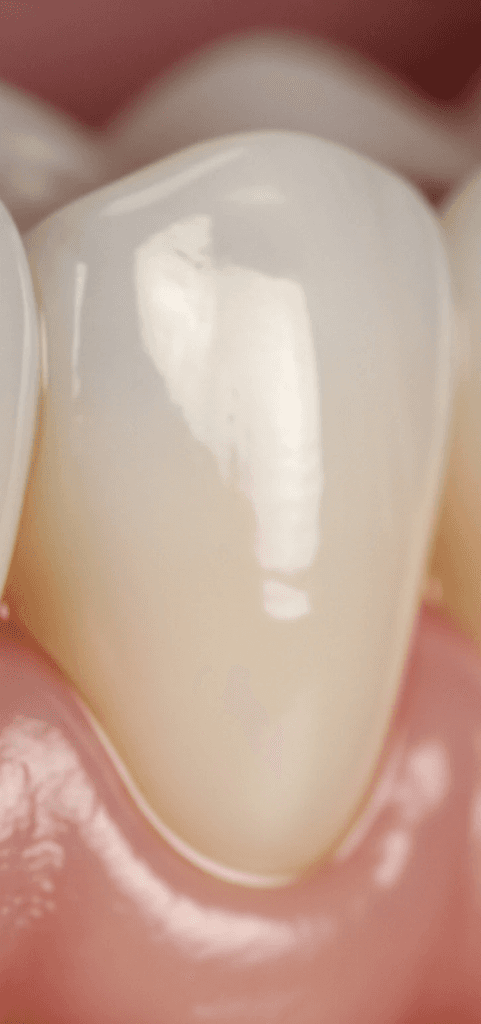 Dental Crown Rochelle Park