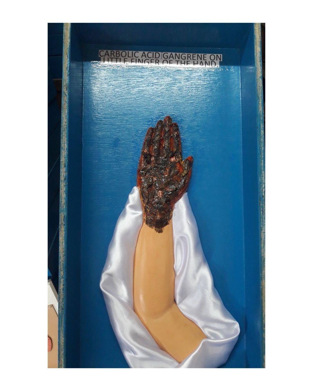 Carbolic Acid Gangrene on Hand