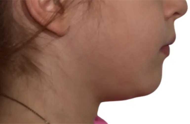 Right after the overlays cementation